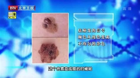 手臂很多痣|为什么很多人的胳膊上都长了一颗痣？医生：出现这5。